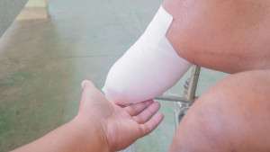 amputation-leg-colin-austin-gbiota