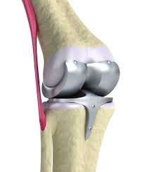 knee-replacement-colin-austin-gbiota